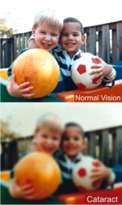 normal vision and cataract clouded vision comparison